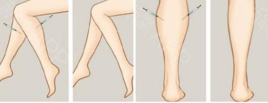 瘦腿抽脂的果好還是細(xì)腿針的果好?