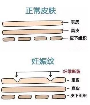 做激光去妊娠紋的果好不好？針對(duì)寶媽產(chǎn)后