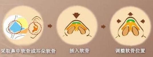 耳軟骨隆鼻尖手術(shù)，時間久了會被吸收嗎？