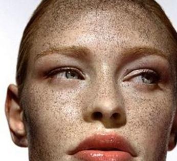 什么原因?qū)е铝嗣娌奎S褐斑產(chǎn)生？如何有的去除？