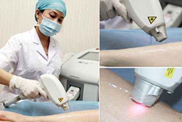 做激光脫毛有副作用嗎？有什么風險嗎？