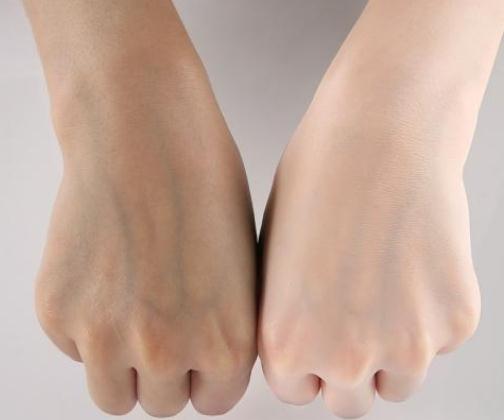 做全身光子美白果好嗎？有后遺癥嗎？