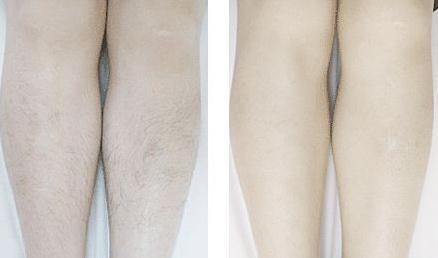 做全身光子美白果好嗎？有后遺癥嗎？