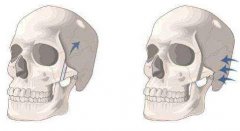 為什么有人做完顴骨手術(shù)后悔死了？真相大公開(kāi)