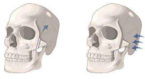 為什么有人做完顴骨手術(shù)后悔死了？真相大公開(kāi)！
