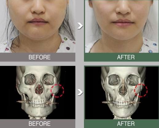 為什么有人做完顴骨手術(shù)后悔死了？真相大公開(kāi)！