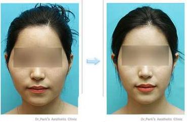 為什么有人做完顴骨手術(shù)后悔死了？真相大公開(kāi)！