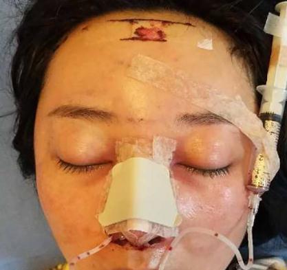 真人的假體隆鼻親身經(jīng)歷告訴你，隆鼻后鼻夾要帶多久？