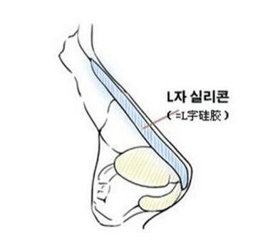 真人的假體隆鼻親身經(jīng)歷告訴你，隆鼻后鼻夾要帶多久？