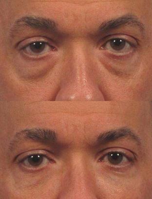 眼袋的形成原因？有哪些方法能有的去除？