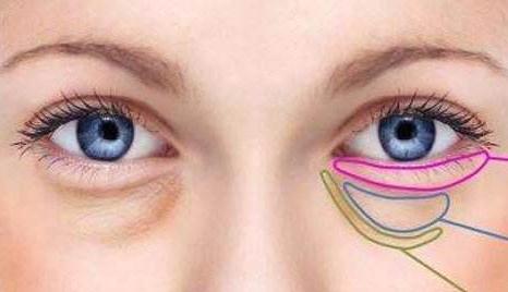 眼袋的形成原因？有哪些方法能有的去除？