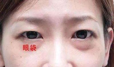 眼袋的形成原因？有哪些方法能有的去除？