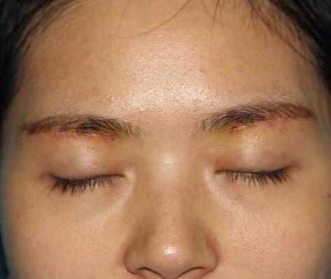 眼袋的形成原因？有哪些方法能有的去除？