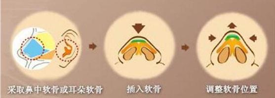 做的耳軟骨墊鼻尖萬(wàn)一被撞歪了可以修復(fù)嗎?怎么修復(fù)？