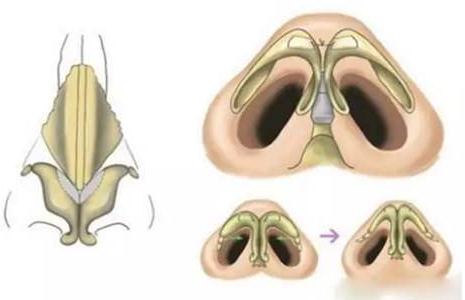 做的耳軟骨墊鼻尖萬(wàn)一被撞歪了可以修復(fù)嗎?怎么修復(fù)？