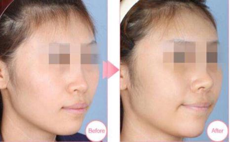 做的耳軟骨墊鼻尖萬(wàn)一被撞歪了可以修復(fù)嗎?怎么修復(fù)？