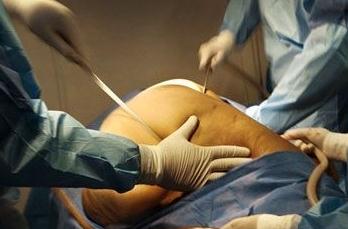 在吸脂豐胸術(shù)前，你需要要了解這些事實！