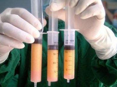 在吸脂豐胸術(shù)前，你需要要了解這些事實！