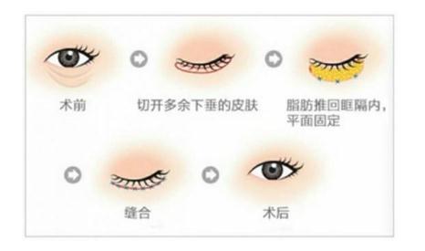 做外切去眼袋容易留疤，是真的嗎？