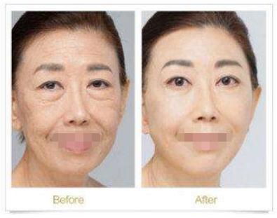 做外切去眼袋容易留疤，是真的嗎？