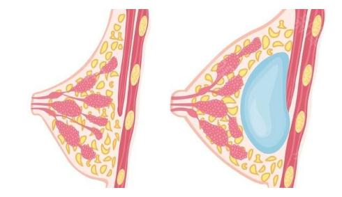 隆胸假體的尺寸應(yīng)該怎樣選擇呢？挑選適合自己的