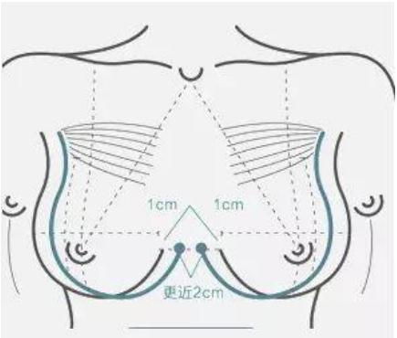 隆胸假體的尺寸應(yīng)該怎樣選擇呢？挑選適合自己的