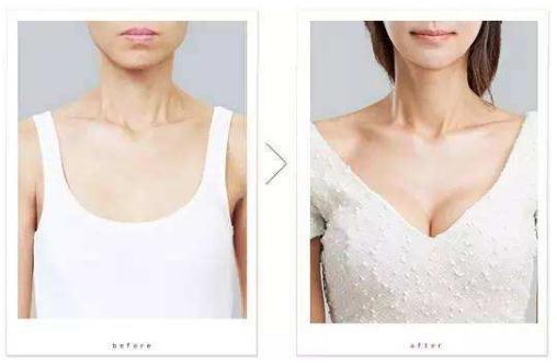 隆胸假體的尺寸應(yīng)該怎樣選擇呢？挑選適合自己的