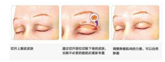 上眼瞼下垂必須要做上瞼提肌手術(shù)嗎？果咋樣？
