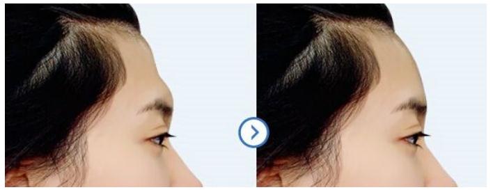 擔(dān)心有副作用，額頭凹陷填充玻尿酸好不好？