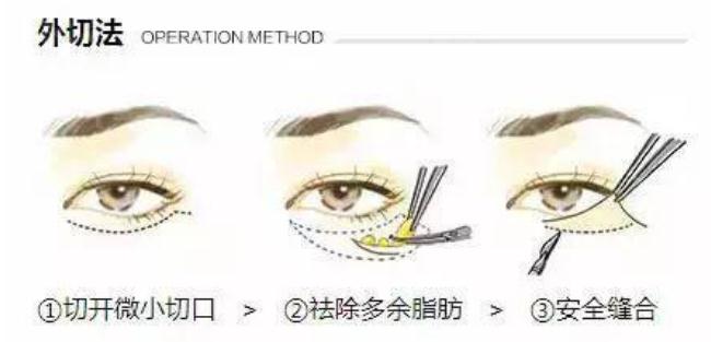 遺傳性眼袋應(yīng)該怎樣有去除？?jī)?nèi)切和外切了解一下~