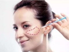 蘋(píng)果肌填充自體脂肪之后，脂肪多久變得穩(wěn)定？