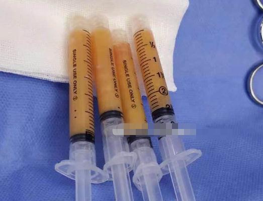 蘋果肌填充自體脂肪之后，脂肪多久變得穩(wěn)定？