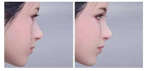 蘋果肌填充自體脂肪之后，脂肪多久變得穩(wěn)定？