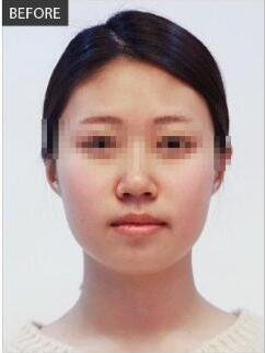 玻尿酸豐下巴維持多久？