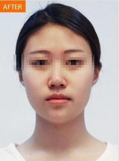 玻尿酸豐下巴維持多久？