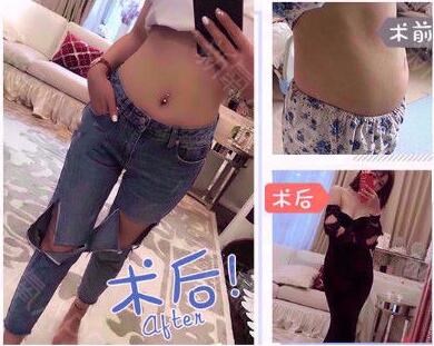 韓國做腰腹環(huán)吸包含哪些部位?是怎么收費(fèi)的?