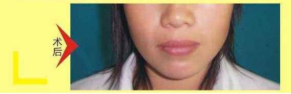 薄唇變厚術(shù)