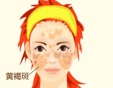 妊娠斑和黃褐斑兩者之間有何區(qū)別？看完就知道了！