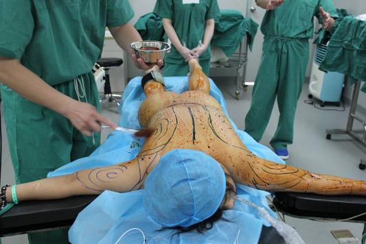 肥胖嚴(yán)重的人，全身吸脂一次性zui多能抽掉多少脂肪？