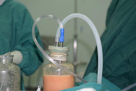 肥胖嚴(yán)重的人，全身吸脂一次性zui多能抽掉多少脂肪？