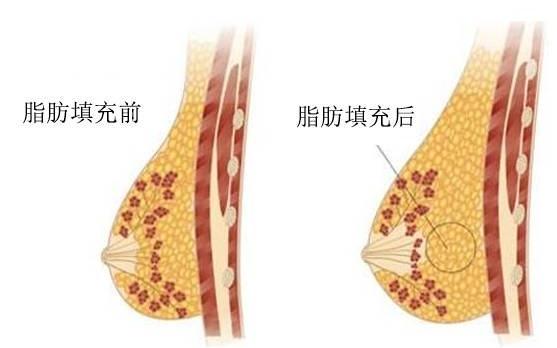 朋友勸我不要做自體脂肪豐胸，這個(gè)手術(shù)有什么后遺癥呢？