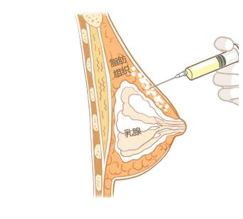 朋友勸我不要做自體脂肪豐胸，這個(gè)手術(shù)有什么后遺癥呢？