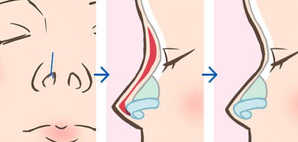 做隆鼻手術(shù)想要修復的話可以完全清除掉嗎？