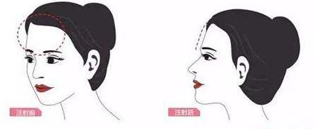 有的人做完自體脂肪填充額頭之后像壽星，原因在這里！