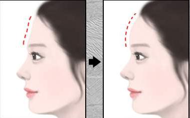 有的人做完自體脂肪填充額頭之后像壽星，原因在這里！