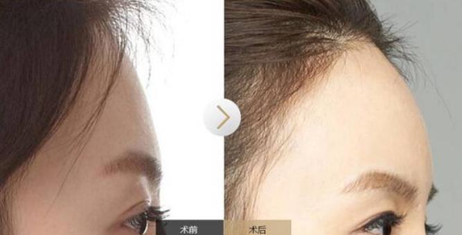 有的人做完自體脂肪填充額頭之后像壽星，原因在這里！