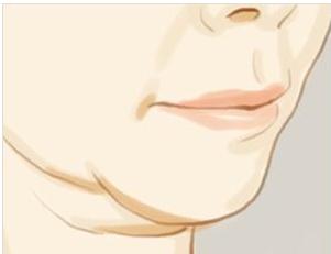 還在猶豫要不要做雙下巴吸脂？你在擔(dān)心后遺癥嗎？