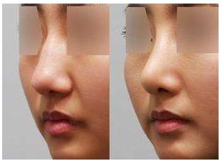 想做耳軟骨隆鼻手術(shù)不一定適合你！先看看哪些情況適合吧？