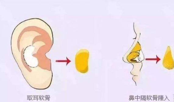 想做耳軟骨隆鼻手術(shù)不一定適合你！先看看哪些情況適合吧？
