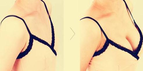 做完假體隆胸手術(shù)，學(xué)會這個趴床方法恢復(fù)快！